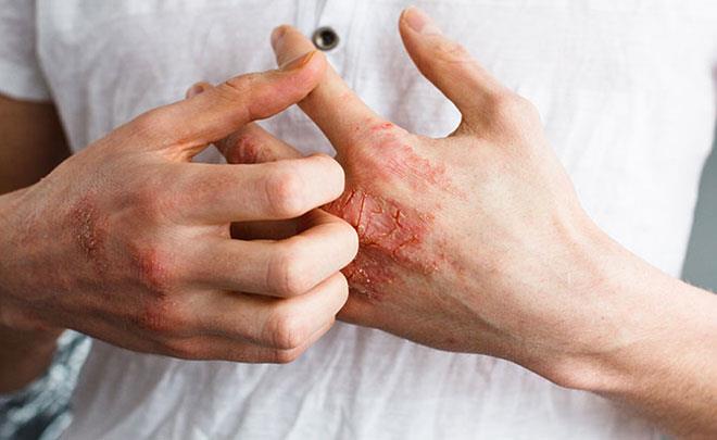 ‌نیشانە و ڕێگا چارەسەرییەکانی نەخۆشی ئەکزیما کامانەن ؟